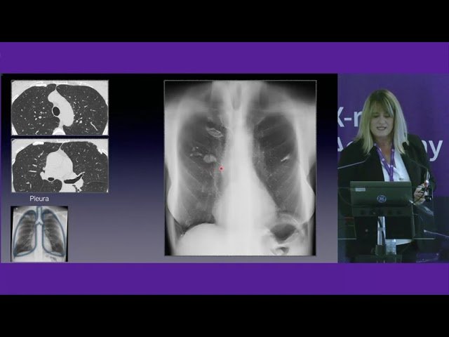 Digital Tomosynthesis in Thoracic Diseases - Current Applications