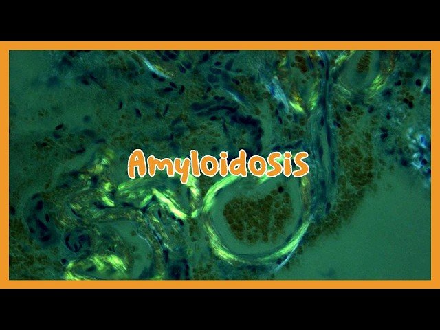 Amyloidosis - Classification and Types Overview