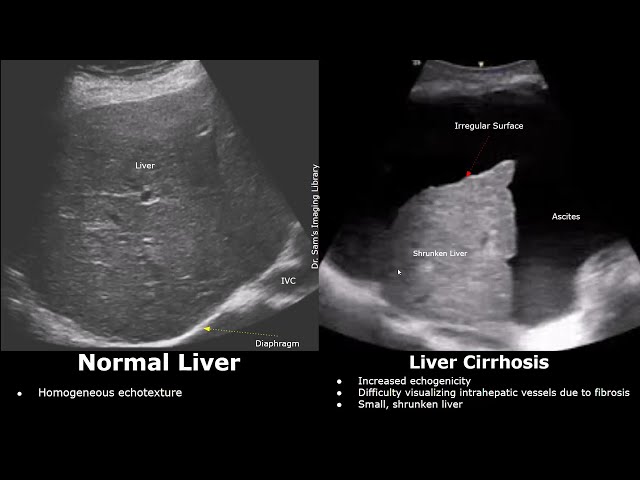 Liver Ultrasound - Normal vs Cirrhosis: Irregular Surface, Coarse Echotexture, Portal Hypertension