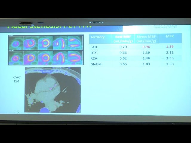 Evaluation of the Coronary Arteries by CT