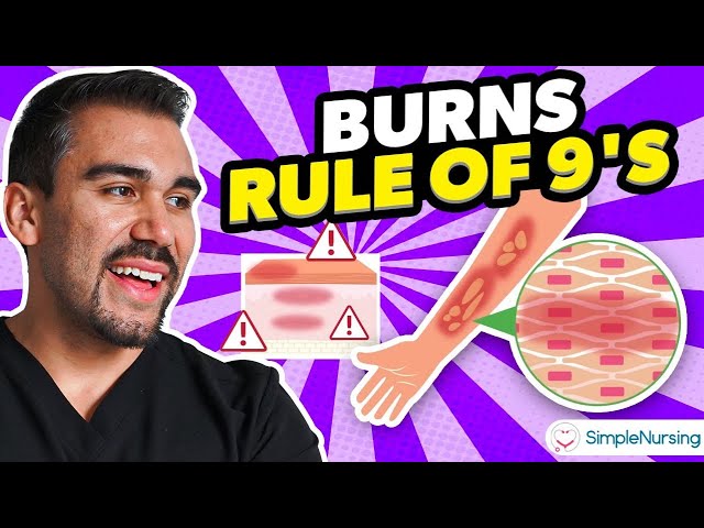 Burns Nursing Overview - Rule of Nines, Types, Causes, Care
