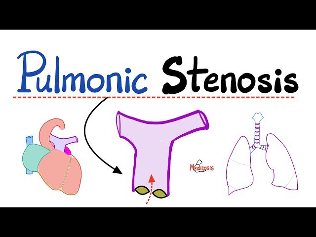 Pulmonic Stenosis and Valvular Heart Disease - Understanding Pulmonic Valve Stenosis