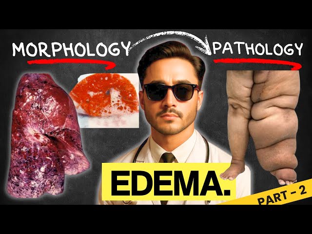 Clinical Features and Morphology of Edema - General Pathology and Pathogenesis