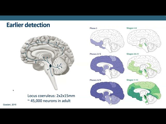 Focus on the Locus Coeruleus to Predict Preclinical Alzheimer's Disease