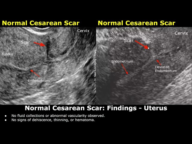 C-Section Ultrasound Reporting - Normal Cesarean Scar, Niche, Bladder Flap Hematoma, Scar Pregnancy