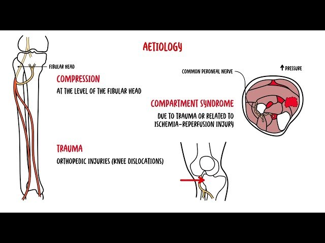 Foot Drop - Common Peroneal Nerve Dysfunction