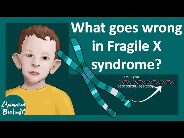 Fragile X Mental Retardation Syndrome - Intelligence and Behavior Issues from FMR1 Gene Mutation