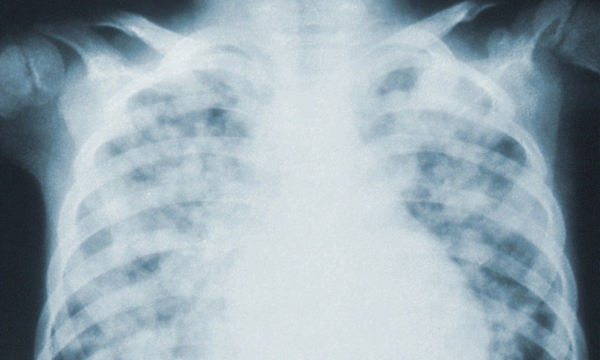 Medical Image Classification using Tensorflow 