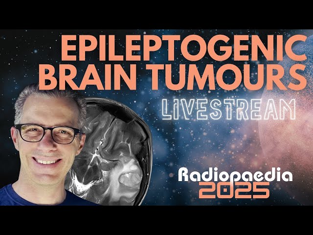 Epileptogenic Brain Tumours