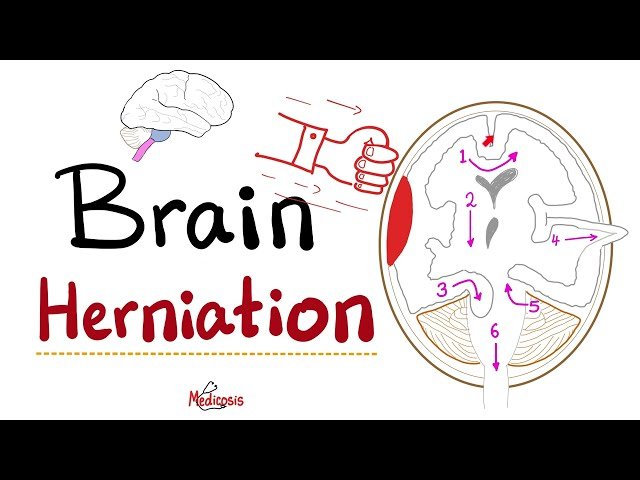 Brain Herniation Types and Clinical Manifestations in Neurological Trauma