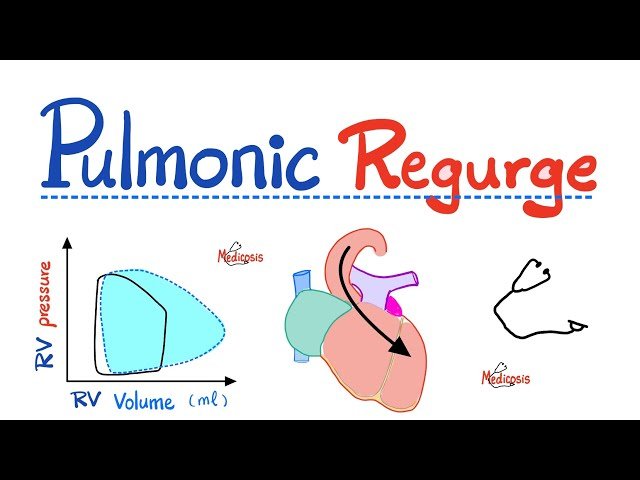 Pulmonary Regurgitation - Pulmonic Insufficiency - Valvular Heart Disease - Cardiology
