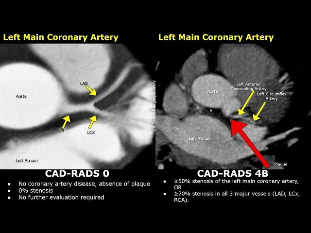 Coronary CT Angiography - Normal CAD-RADS 0 vs CAD-RADS 4 Cases with Severe Atherosclerosis