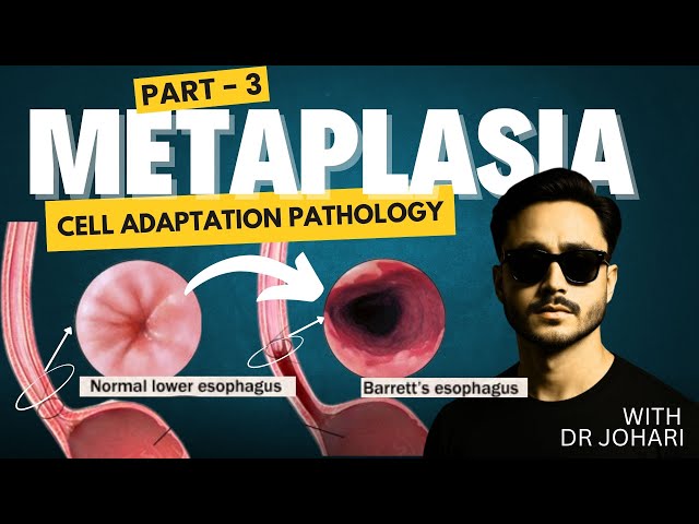 Metaplasia Cell Adaptation Pathology - Barrett's Esophagus Metaplasia Pathology - General Pathology