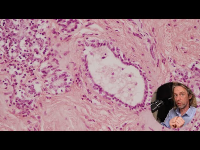Histology of the Breast: Understanding Cellular Changes and Implications for Breast Cancer