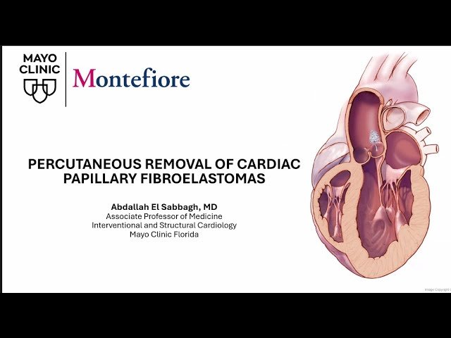 Percutaneous Removal of Cardiac Papillary Fibroelastomas